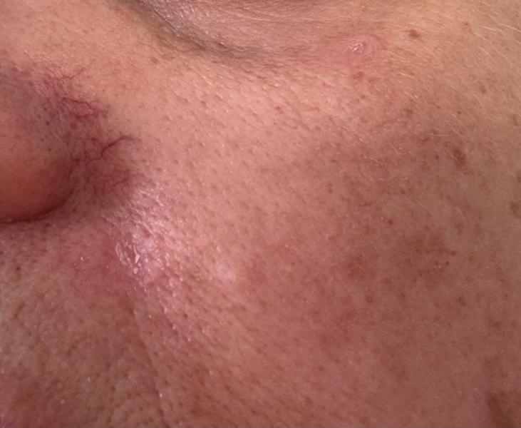 Mole/skin tag removal