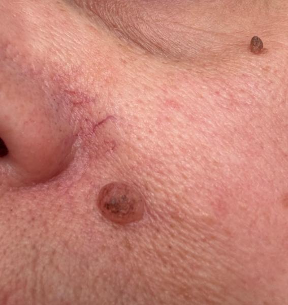 Mole/skin tag removal