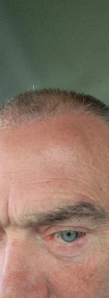 5 star treatment Lipoma removal on forehead