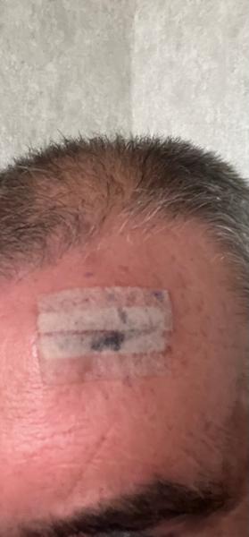 5 star treatment Lipoma removal on forehead